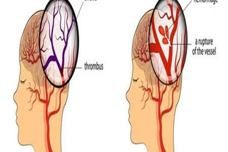 6 إشارات تنذركم بأن جلطة دماغية على وشك الحدوث
