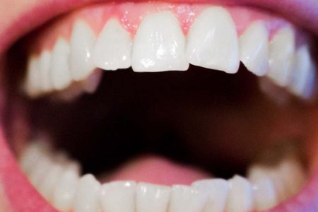 كيف نتخلص من تسوس الأسنان طبيعياً ؟