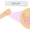 حلول طبيعية للصدفية