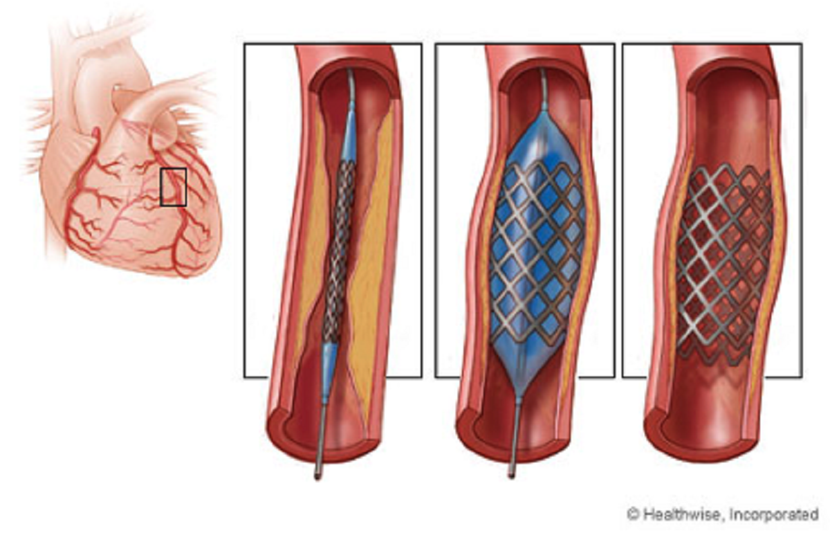 عمليات دعامات القلب